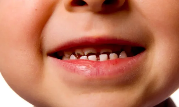 **راهکارهای موثر برای حذف لکه‌های سیاه از دندان کودک در محیط خانگی**