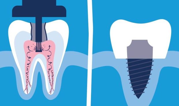 آیا برای ایمپلنت دندان ریشه لازم است؟