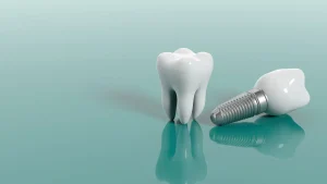 آیا برای ایمپلنت دندان ریشه لازم است؟