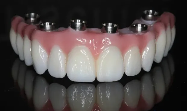 آیا ایمپلنت تمام دندان‌ها ممکن است؟