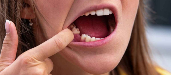 پنج عامل مهم در لق شدن دندان‌های دائمی