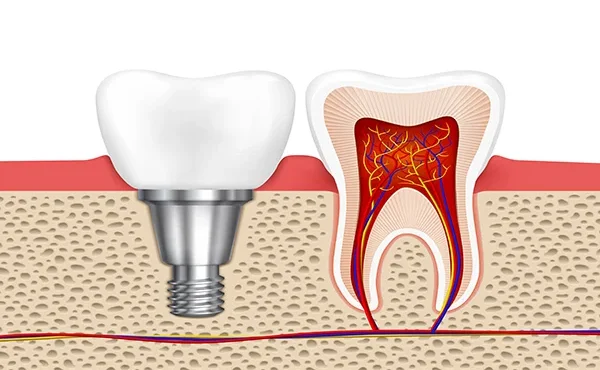 اهمیت و روش‌های جلوگیری از عفونت ایمپلنت دندانی