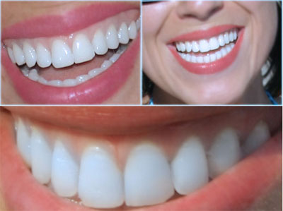 تعداد دندان‌هایی که طرح لبخند شامل می‌شود چقدر است؟