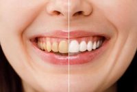 آیا لمینت دندان به دندان آسیب می‌زند؟