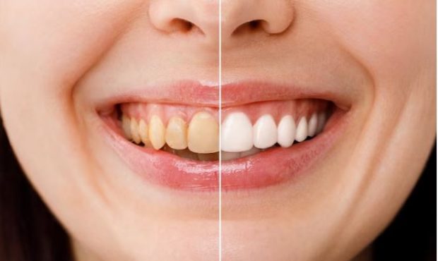 آیا لمینت دندان به دندان آسیب می‌زند؟