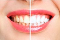 مقایسه لمینت دندان و بلیچینگ: تفاوت‌ها و انتخاب مناسب