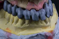 “راهکار ایمپلنت دندان برای اصلاح طرح لبخند: زیبایی و عملکرد در یک جا”