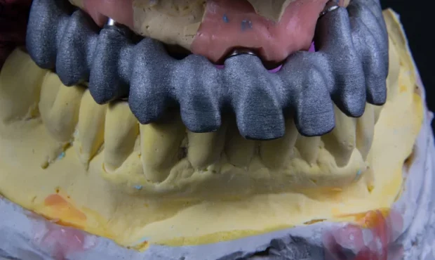 “راهکار ایمپلنت دندان برای اصلاح طرح لبخند: زیبایی و عملکرد در یک جا”