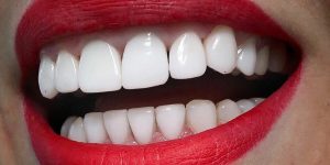 آشنایی با فرایند و محصولات دندان‌پزشکی: اسیداچ، کامپوزیت و سایر محصولات