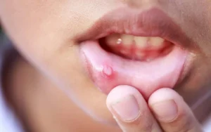خواص شگفت‌انگیز رب انار در درمان آفت دهان