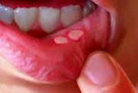 خواص شگفت‌انگیز رب انار در درمان آفت دهان