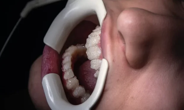 چگونگی تأثیر قهوه بر رنگ لمینت دندان