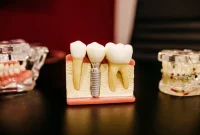 تفاوت و مقایسه دندان مصنوعی متحرک و ایمپلنت دندان