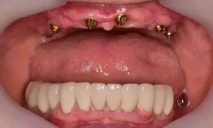 چرا ایمپلنت‌های دندان ممکن است لغزیده شوند؟
