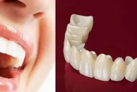 روکش های زیرکونیا: راهکاری زیبا برای ترمیم های دندانی کودکان و بزرگسالان