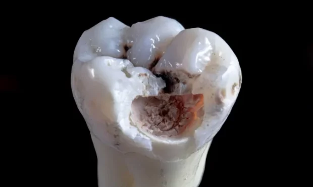 پیشگیری و مدیریت آسیب به عصب ناشی از ایمپلنت در دندان‌پزشکی