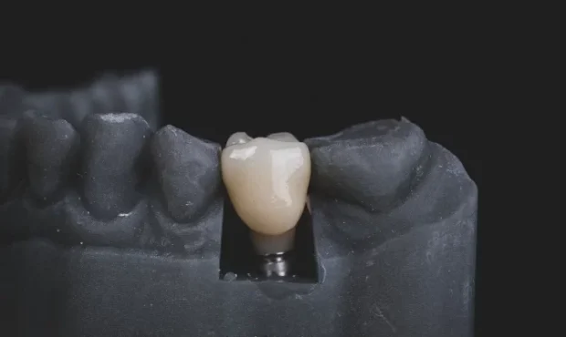 ایمپلنت دندان: ممنوعیت‌ها و شرایط مورد نیاز