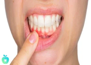 راه‌های مقابله با آبسه یا عفونت دندان و درمان آن