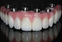 آیا امکان ایمپلنت‌سازی تمام دندان‌ها وجود دارد؟