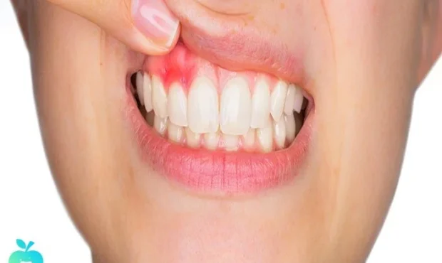 راه‌های مقابله با آبسه یا عفونت دندان و درمان آن