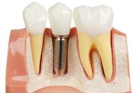 ایمپلنت دندان: تفاوت‌ها بین کشورهای سازنده