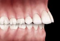 ناهنجاری فکی و دندانی: اورجت و راه‌های درمان