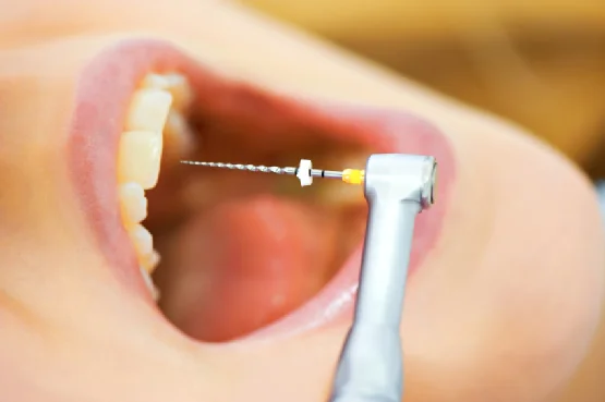 معرفی و انواع کانال‌های دندان