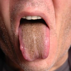 علل و انواع پوشش قهوه‌ای زبان: ۹ دلیل و نشانه‌های مختلف